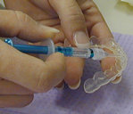Teeth whitening