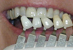 Teeth whitening